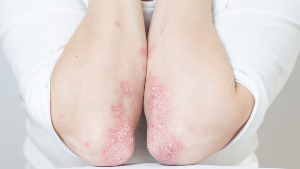 Understanding Psoriasis and Why Regeneration Matters Understanding Psoriasis and Why Regeneration Matters